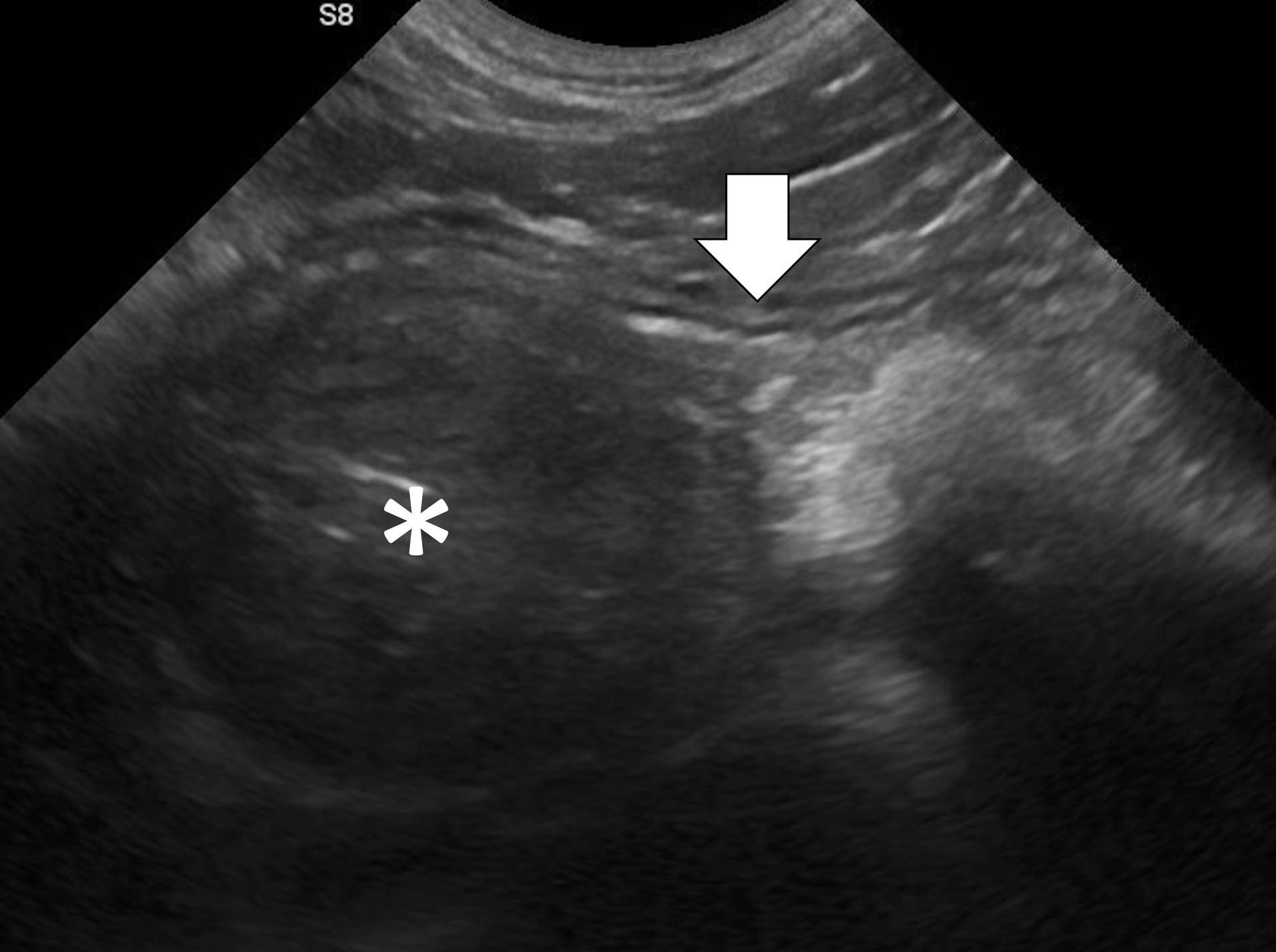 Foreign Body Examples Diagnosing Foreign Body Obstructions via Ultrasonography