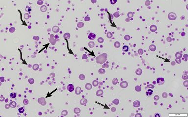 Top 5 False Complete Blood Count Results | Clinician’s Brief